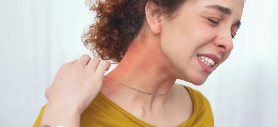 Are Hives Contagious? A Simple Guide