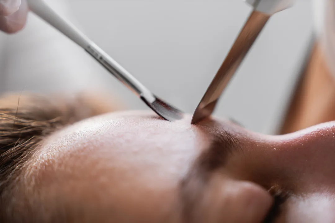 ultrasonic cleaning of the skin close up - What Are Blackheads? Causes, Removal & Prevention - Palm Beach Dermatology Group