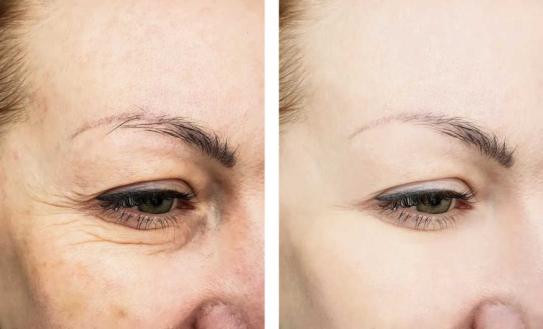 Botox Brow Lift: What You Should Know // What is a Botox Brow Lift? // How Does Botox Lift the Brows? // Which Muscles Are Involved? // Benefits of a Botox Brow Lift // Who is a