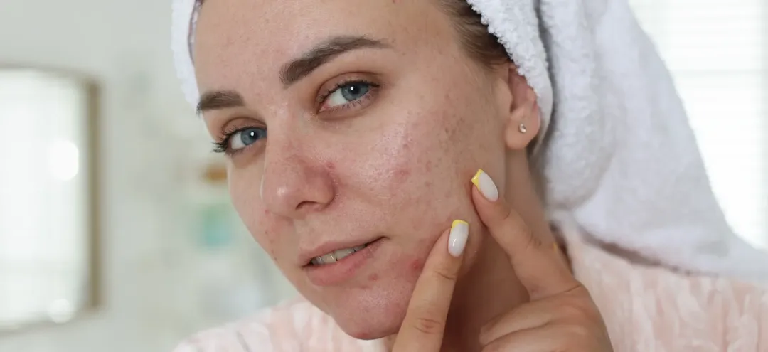 Can Dry Skin Cause Acne? What You Need to Know - young woman with natural skin posing in bathroom