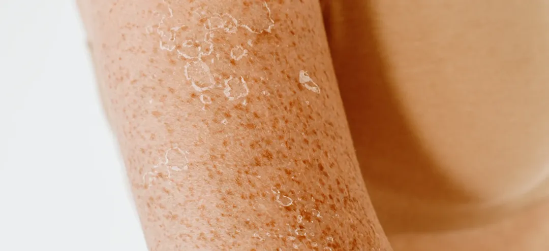 close up view of skin with sun damage - Can Dry Skin Cause Spots? Causes, Myths & Routine Guide