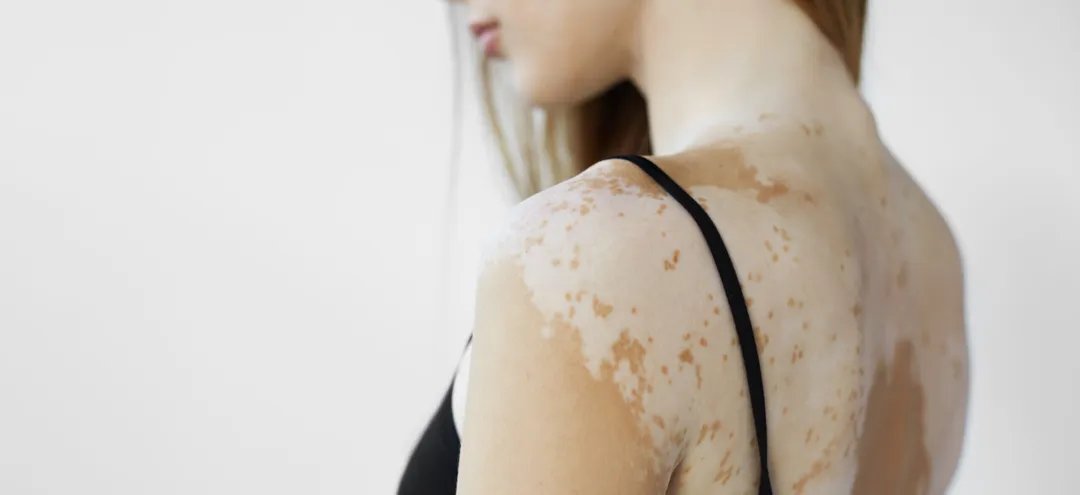 Can White People Have Vitiligo?