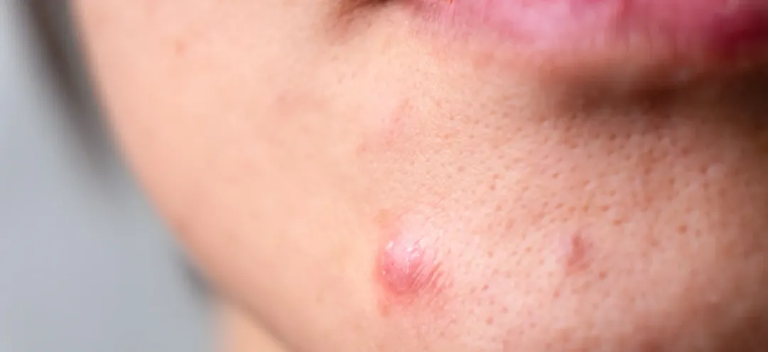 Cystic Acne - Causes, Symptoms & Treatment