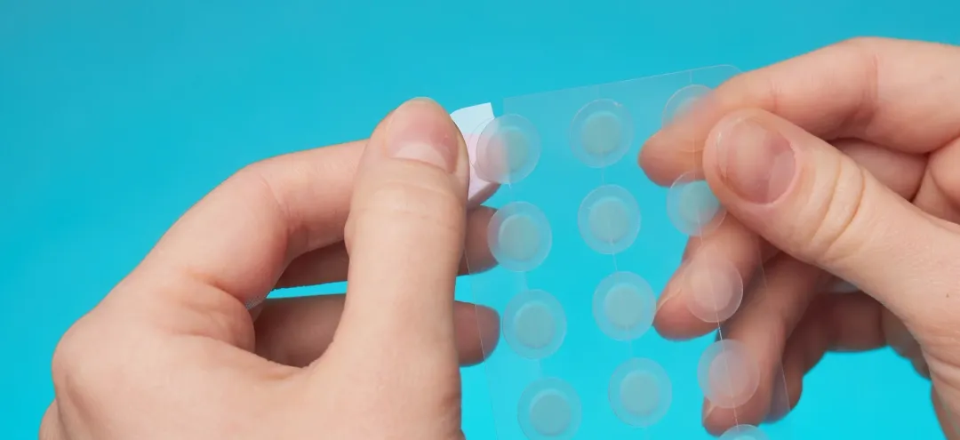 close up round acne patch on finger on blue - Do Pimple Patches Work on Blackheads?