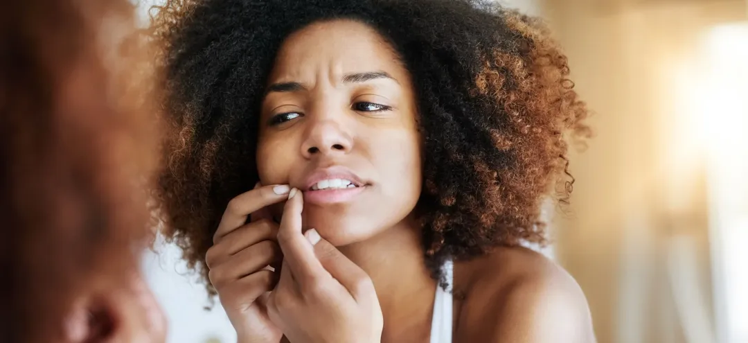 When her skin has acne - Do Whiteheads Disappear on Their Own? Causes and Treatment