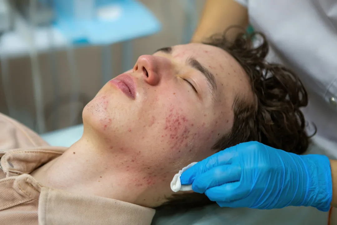 Treatment of acne in adolescents. Facial peeling to fight acne on the face - Do Whiteheads Disappear on Their Own? Causes and Treatment