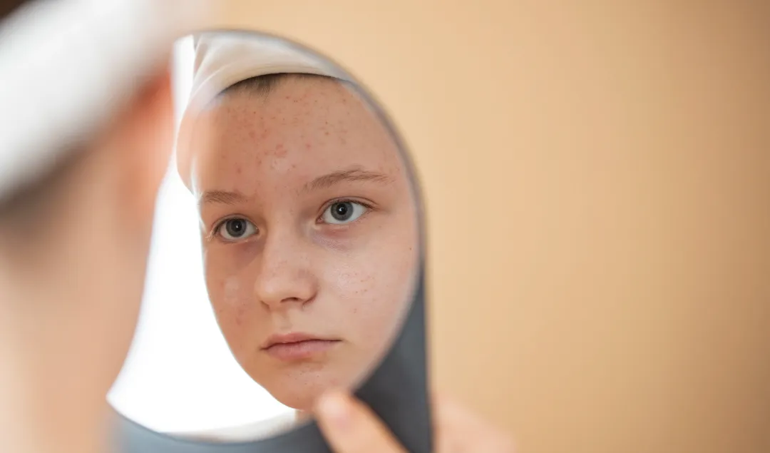 teen looks in mirror at face - Does Accutane Help Hormonal Acne?