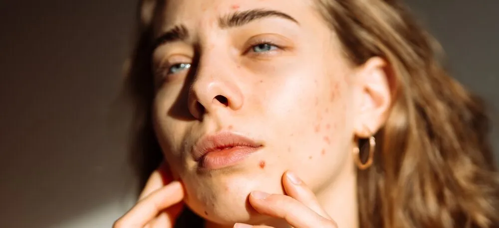 Does Coffee Cause Acne