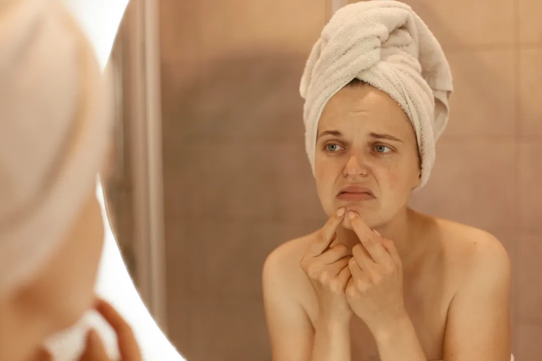 sad unhappy young adult woman wearing bath towel squeezing acne chin mirror reflection female with pimples her face skin problems skin care - Does Dairy Cause Acne? Causes, Signs