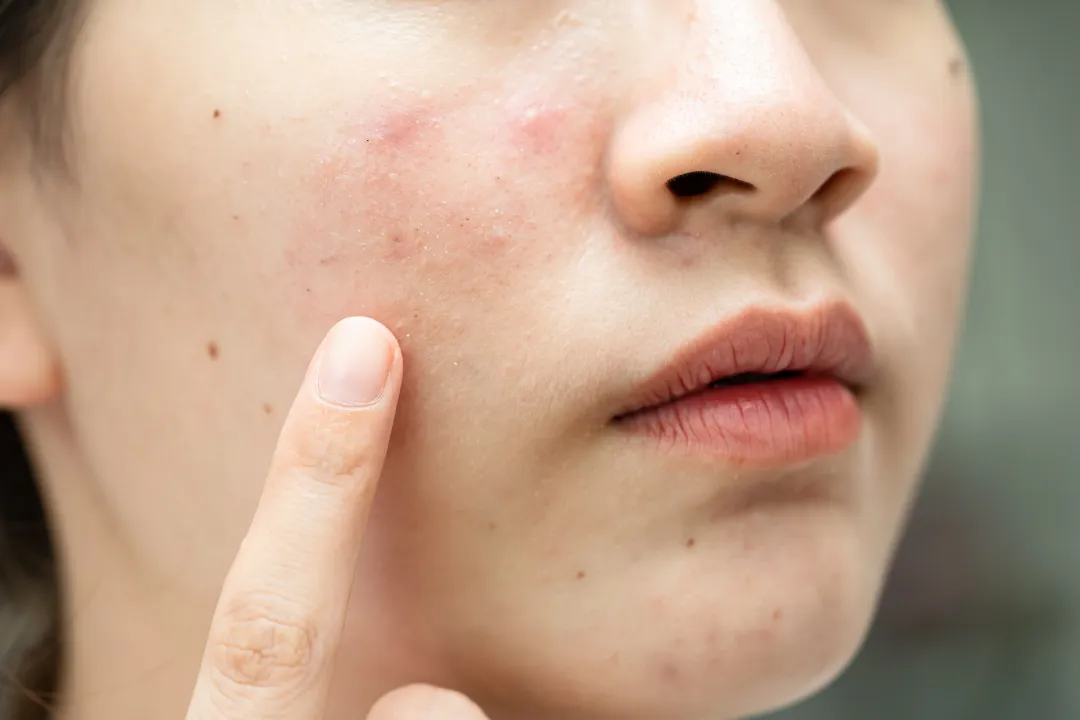 asian young with pimple acne scar on skin facial - Does Tea Tree Oil Help With Acne?