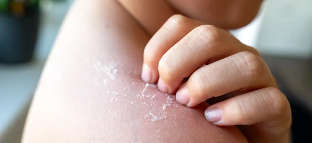 child hand scratching skin flaking on shoulder - Dry Skin: Causes, Prevention & Treatment