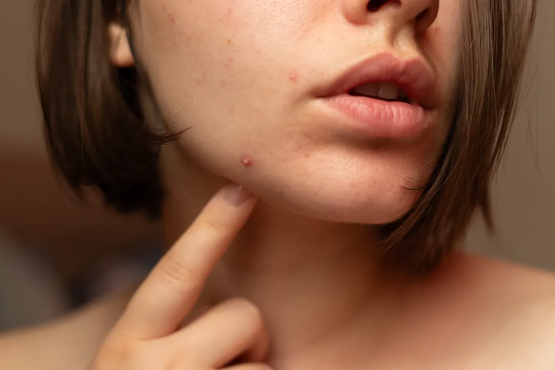 How to Get Rid of Forehead Acne: Simple Tips for Clear Skin - How to Prevent Forehead Acne - Simple Skincare Habits for Clear Skin - Palm Beach Dermatology Group - PGA Dermatology