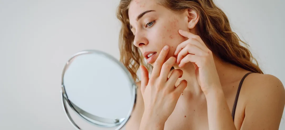 How to Get Rid of Forehead Acne: Simple Tips for Clear Skin - How to Prevent Forehead Acne - Simple Skincare Habits for Clear Skin - Palm Beach Dermatology Group - PGA Dermatology