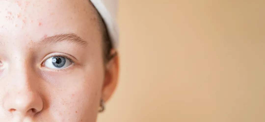 Teen girl with acne problem - Hormonal Acne - A Complete Guide - Palm Beach Dermatology Group - PGA Dermatology