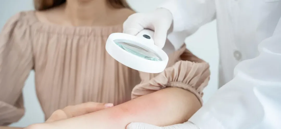 How Long Do Hives Last?