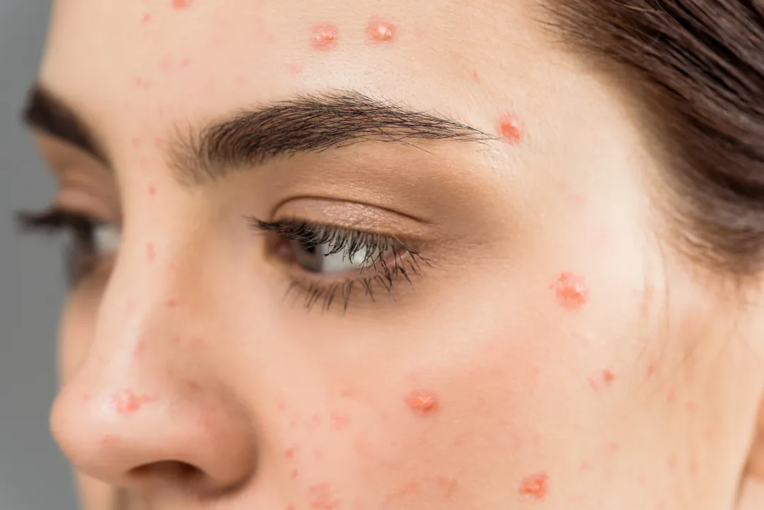 close up of woman with pimples on face isolated on grey - How Long Does Cystic Acne Last? A Simple Guide
