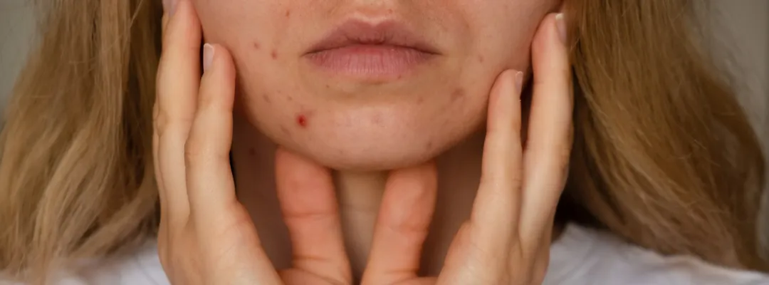 Unrecognizable woman showing her acne on face. Banner Close-up acne on woman's face with rash skin - How Long Does Cystic Acne Last? A Simple Guide