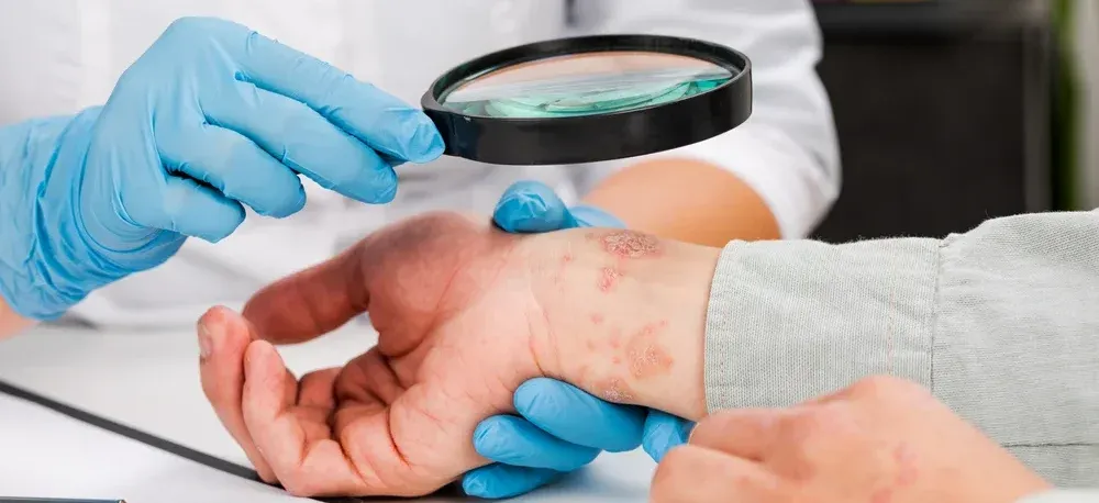 How to Cure Eczema Permanently?