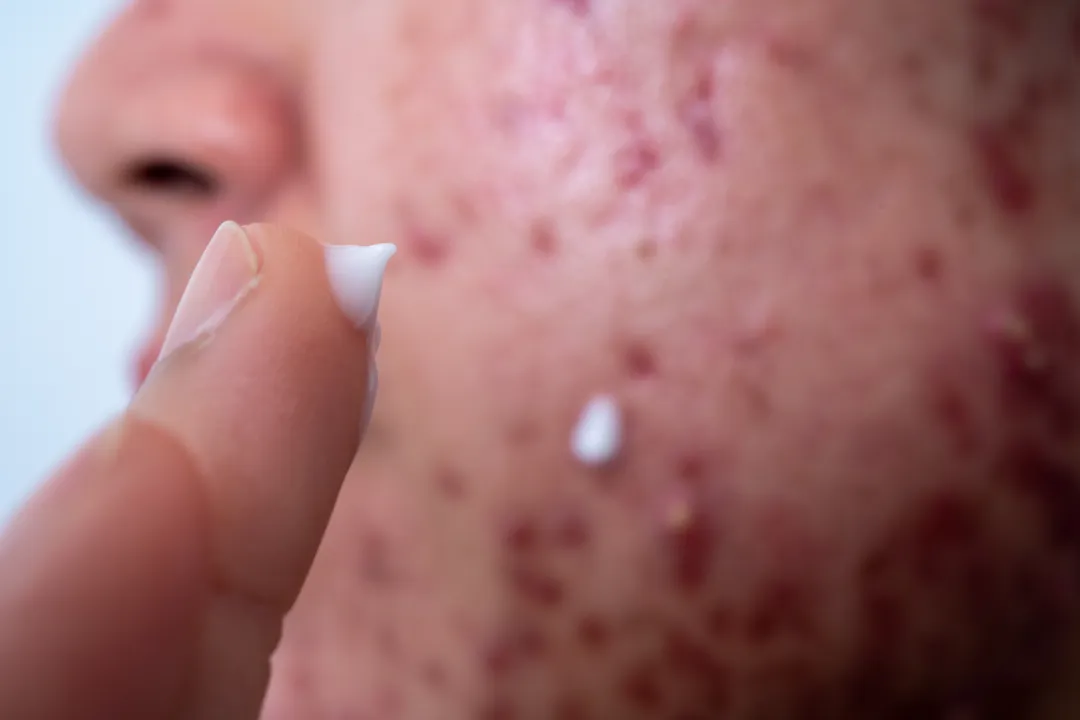 Acne on face because the disorders of sebaceous glands productions. Acne or a Cosmetic - How To Get Rid of Cystic Acne? - Palm Beach Dermatology Group