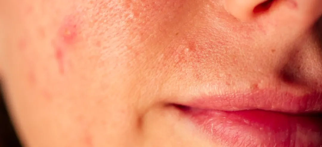 post-acne, scars and red festering pimples on the face of a young woman. - How to Get Rid of Fungal Acne? - Palm Beach Dermatology Group in Florida - PGA Dermatolgoy