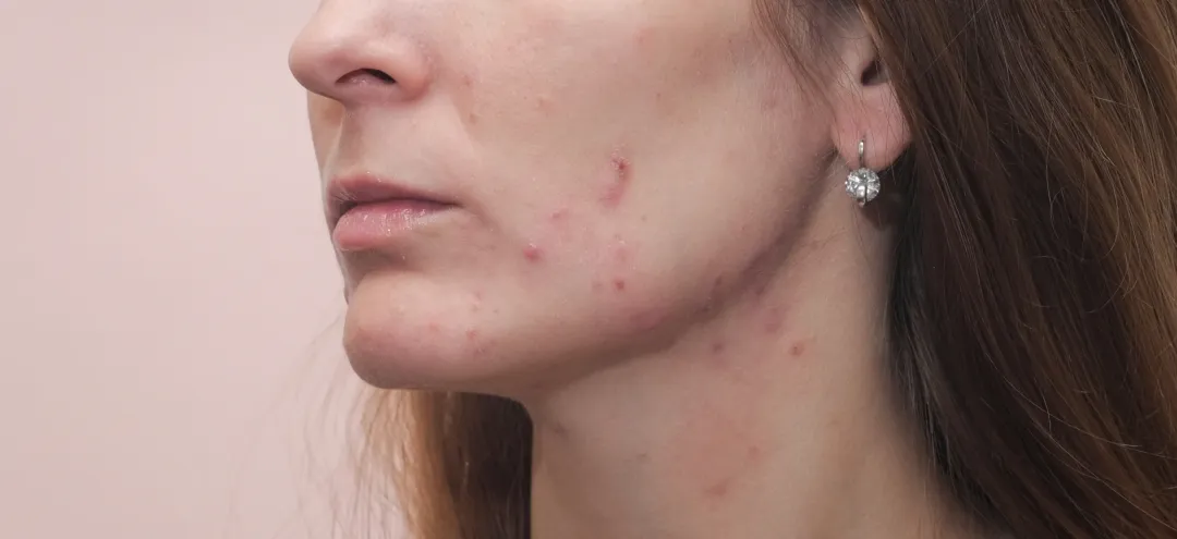 close up of woman face with skin imperfections - How to Treat Hormonal Acne? A Complete Step by Step Guide - Palm Beach Dermatology Group