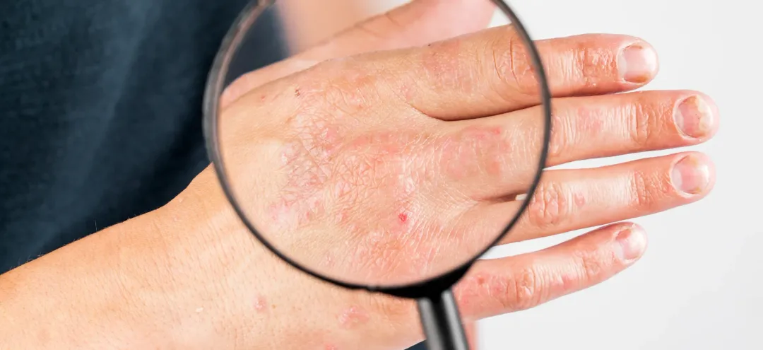 Is Eczema an Autoimmune Disease? What You Really Need to Know