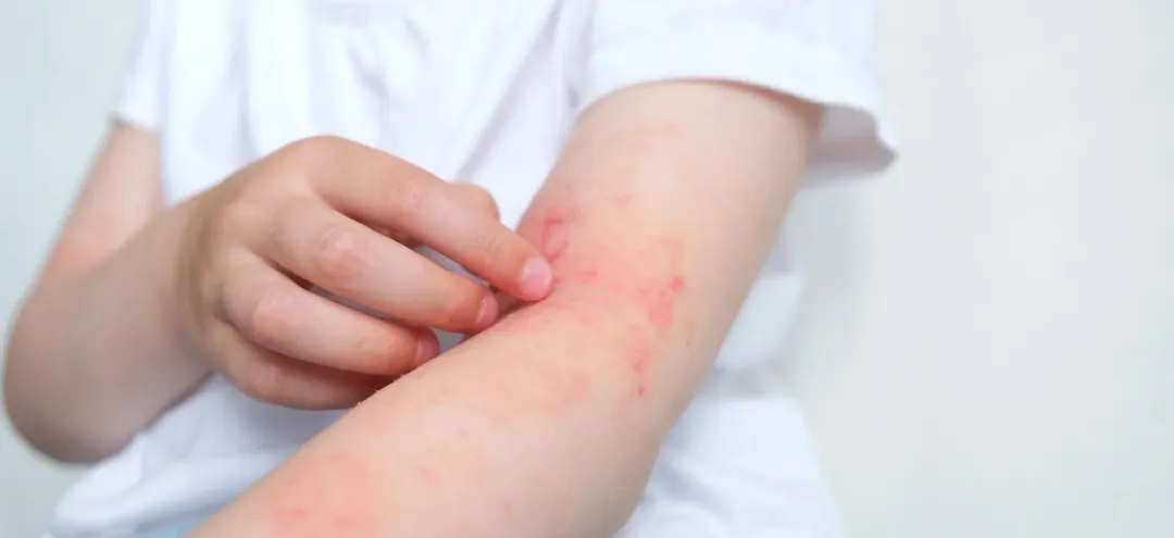 Is Eczema Contagious?