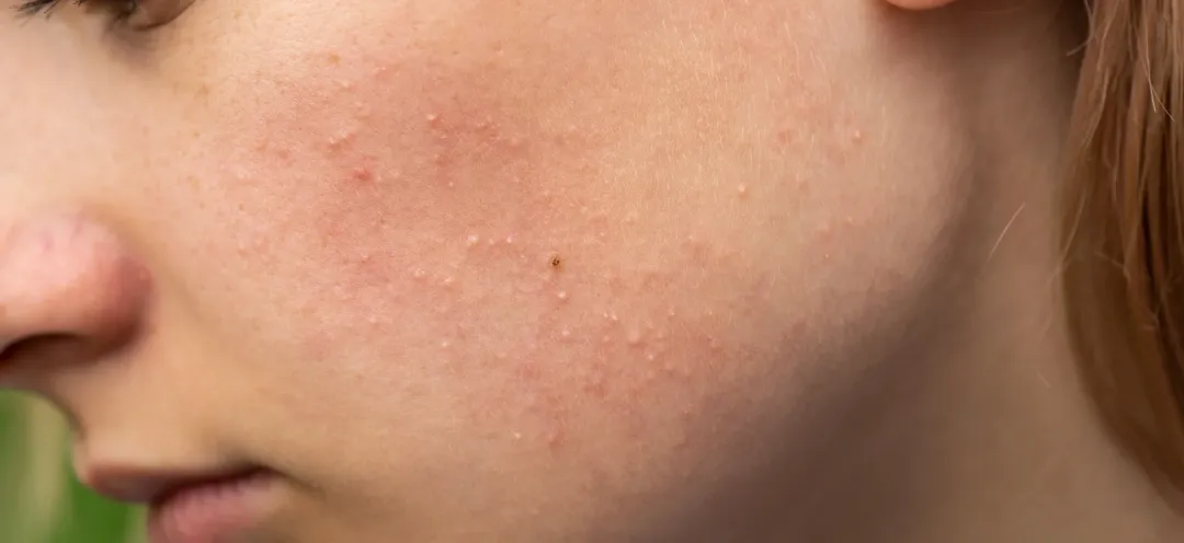 Is fungal acne contagious? - Palm Beach Dermatology Group