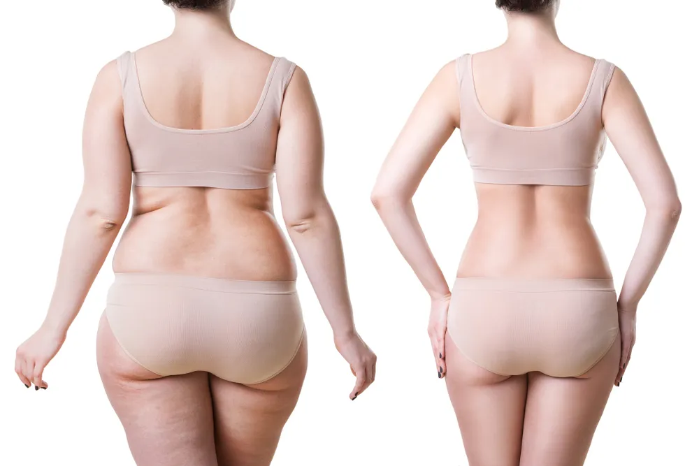 Is Liposuction Safe? What You Need to Know - What is Liposuction? - Types of Liposuction - Benefits of Liposuction