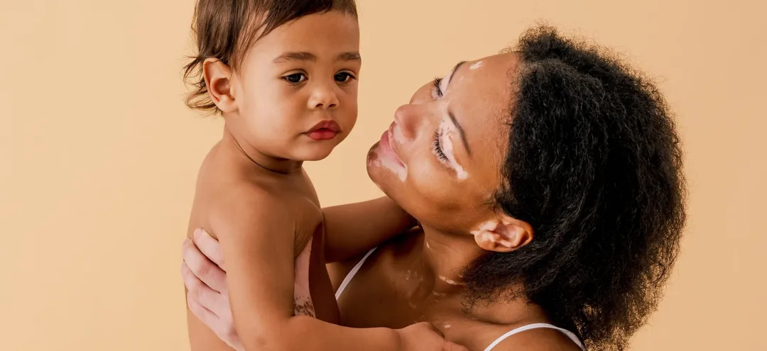 Is Vitiligo Genetic? A Complete Guide