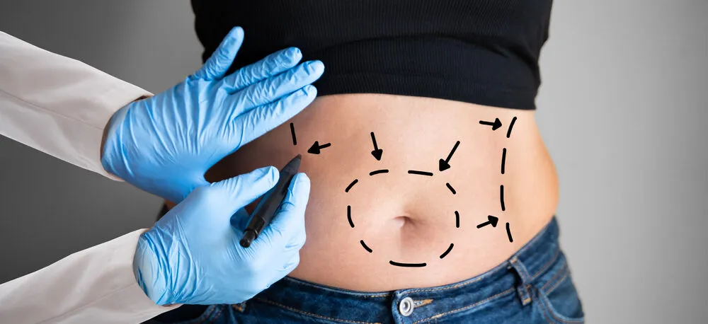 Does Liposuction Leave Scars? - Understanding the Liposuction Procedure - Tumescent Liposuction - Laser-Assisted Liposuction (LAL) - Ultrasound-Assisted Liposuction (UAL) - Do