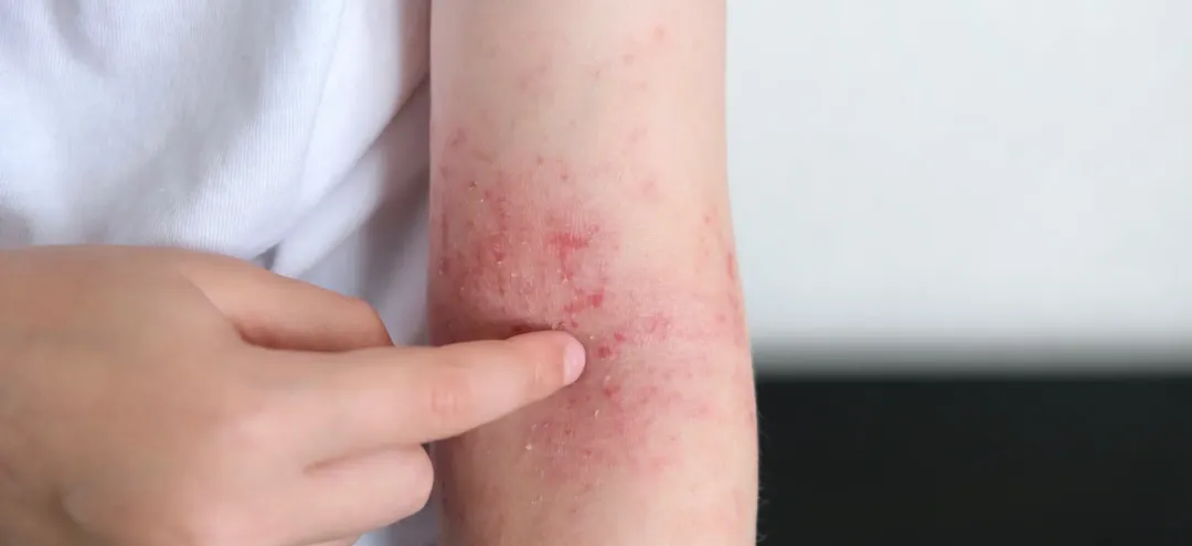 arm with red rash and irritation in studio - Psoriasis vs Eczema: Understanding the Key Differences