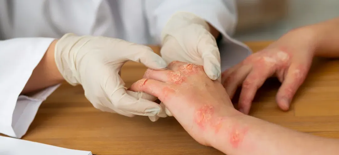 Safest Eczema Treatments: Effective Solutions for Skin Health