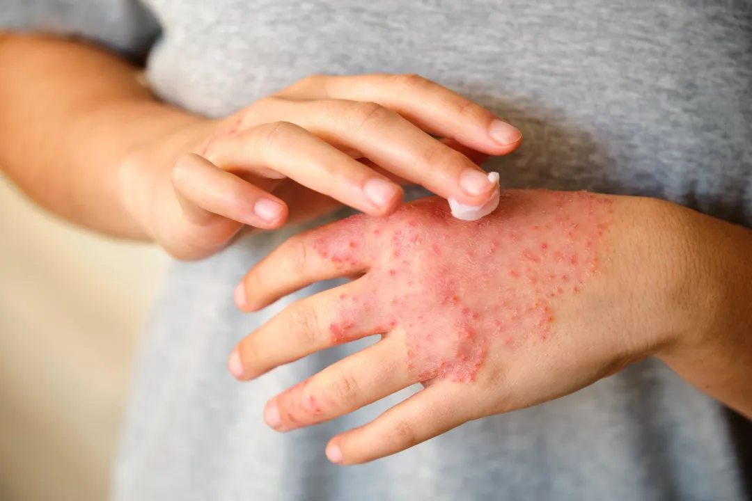 Adult Applying cream to irritated hand - Is Vaseline Good for Eczema? Benefits, Drawbacks & Best Ways To Use it - Palm Beach Dermatology Group