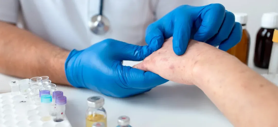 What Are Hives? Causes, Diagnosis, Types & Treatment