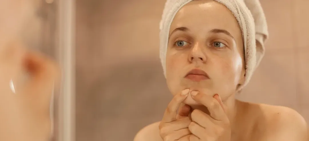 What Are Whiteheads? A Complete Guide to Causes and Treatments