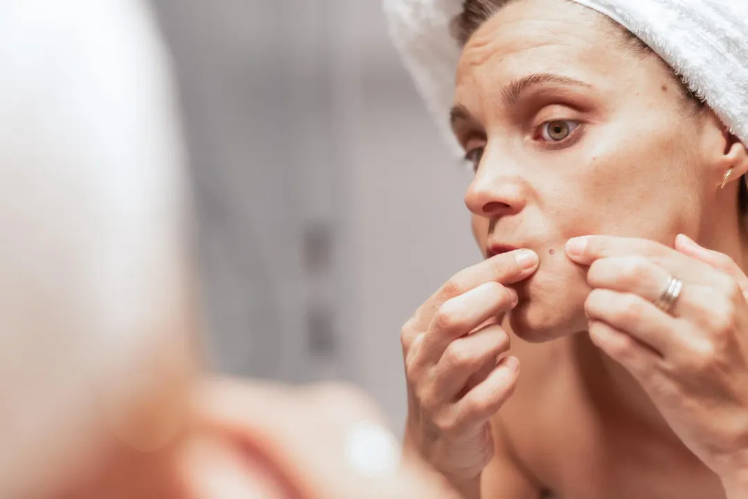 What Are Whiteheads? A Complete Guide to Causes and Treatments