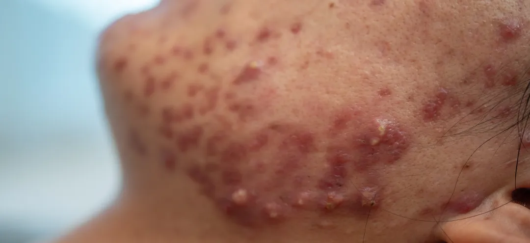 Acne on face because the disorders of sebaceous glands productions. Acne or a Cosmetic - What Causes Fungal Acne? A Simple Guide - Palm Beach Dermatology Group - PGA Dermatology
