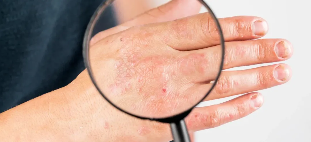 What Causes Hives? Everything You Need To Know