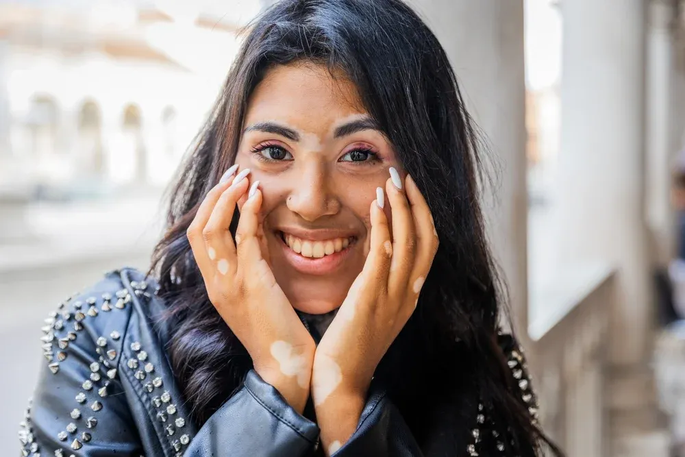 Portrait of a smiling teenage girl with vitiligo touching her face with her hands.