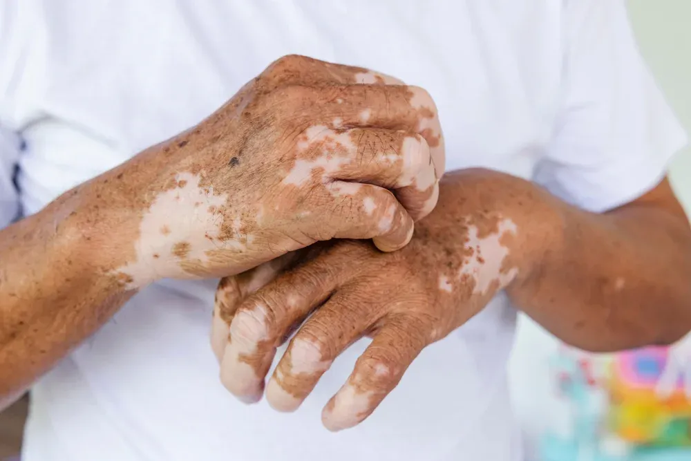 Close-up Vitiligo on skin hands of old people. medical condition causing depigmentation of patches of skin