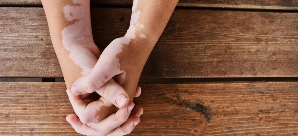 A woman holding hands on a wooden background. has skin disorder called vitiligo - white patches caused by loss of pigmentation
