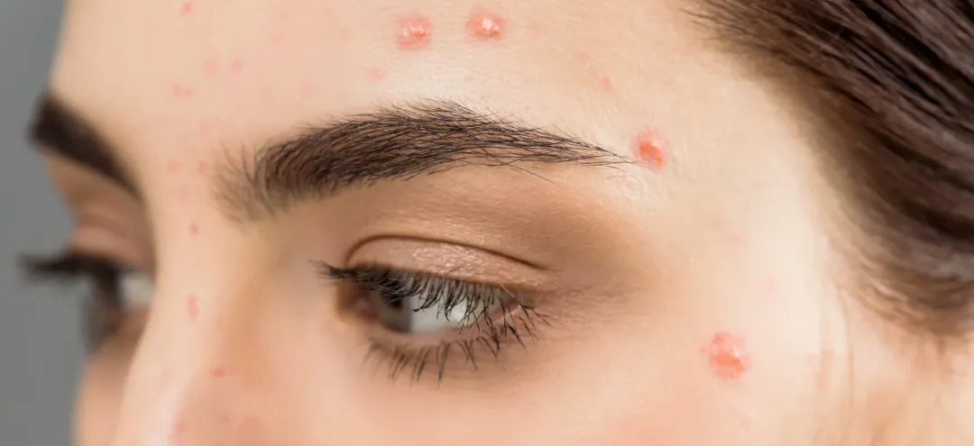close up of woman with papule on face