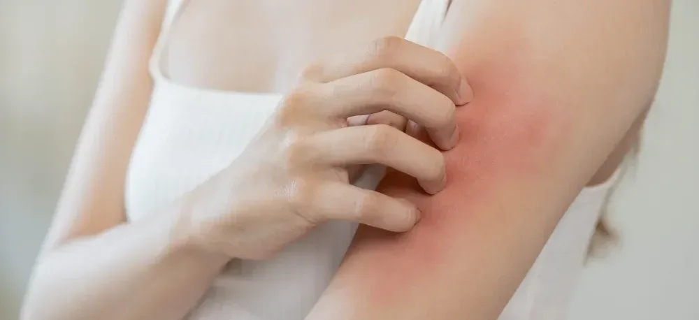 What is Eczema? A Simple Guide to Symptoms, Causes, and Treatment