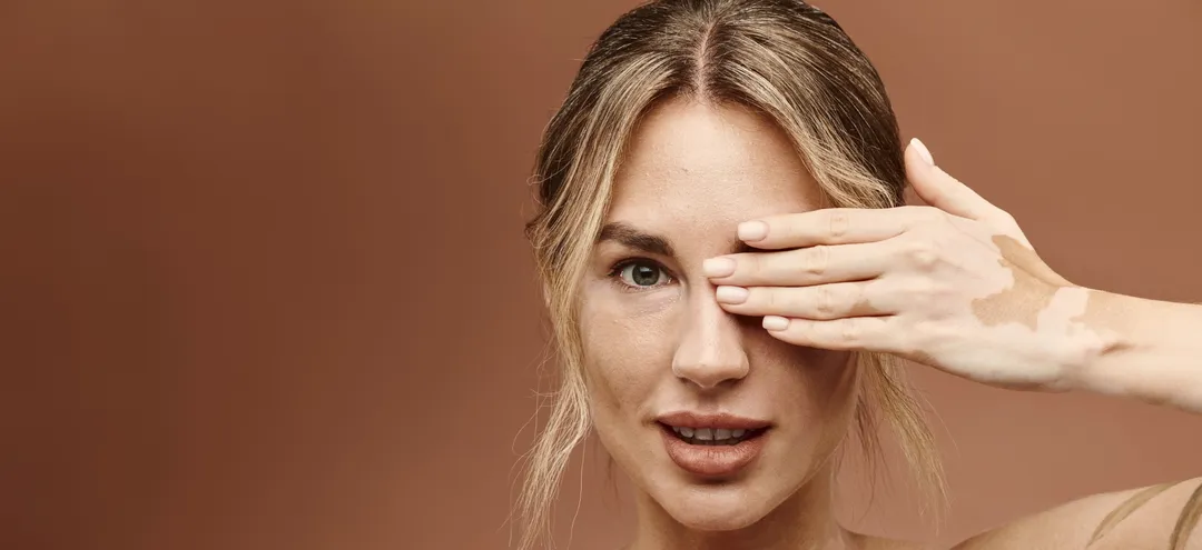 What is Vitiligo? A Simple Guide