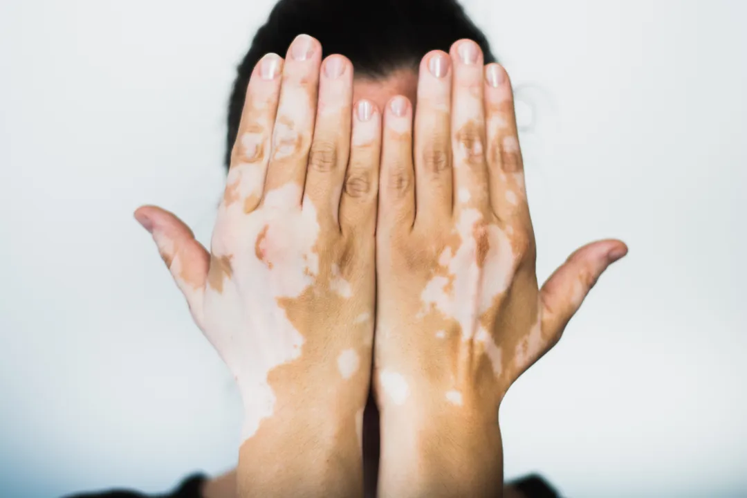 What is Vitiligo? A Simple Guide